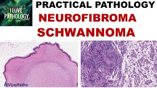 Neuroblastoma and Ganglioneuroma  Adventures in Neuropathology [upl. by Tuinenga]