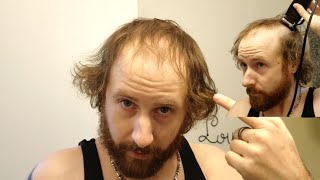 BALDING MAN Shaves Head Bald TOTALLY TRANSFORMING His Look [upl. by Pitarys150]