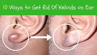 10 Ways to Get Rid Of Keloids on Ear  keloid Scar Removal [upl. by Narik859]