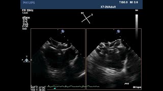 Echocardiography Essentials Mastering the apical fourchamber view 4CV [upl. by Alexei]