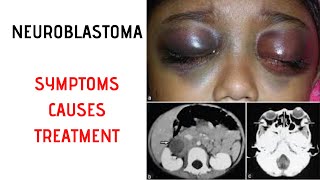 NEUROFIBROMA AND SCHWANNOMA Clinical features amp Morphology [upl. by Blynn836]