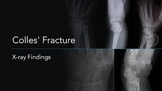 Colles Fracture Xray Findings [upl. by Horn]