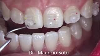 Orthodontic Brackets Bonding step by step [upl. by Edwards]