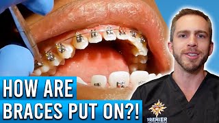 How Are Braces Put On [upl. by Cormier]