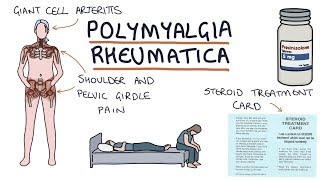 Polymyalgia Rheumatica Visual Explanation for Students [upl. by Buroker]