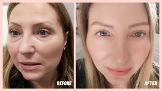 Under Eye Filler  Before amp After  My Experience [upl. by Ahsirahc]